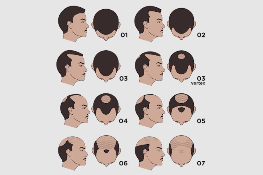 Male Pattern Hair Loss