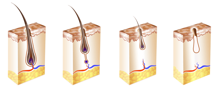 How Miniaturisation Relates To Hair Loss & Thinning